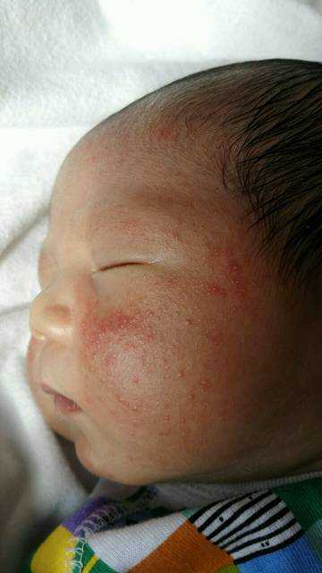 新生宝宝脸上红疹是热的还是奶癣?_宝宝出生