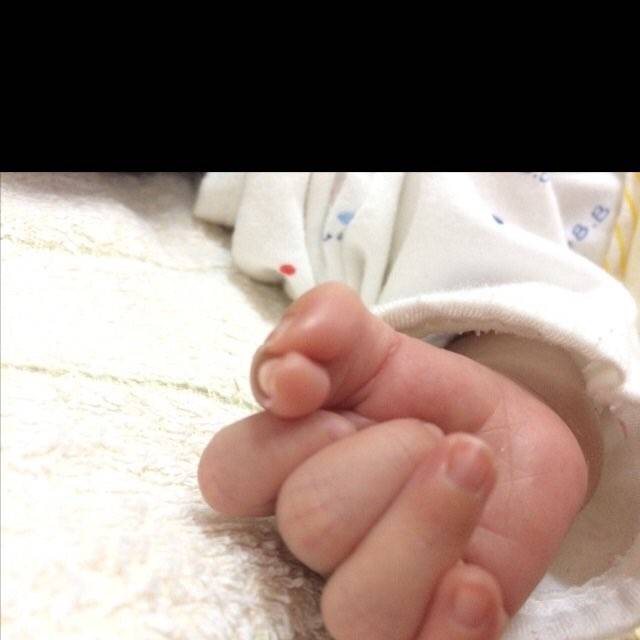 祈福,宝宝右手大拇指并指畸形!