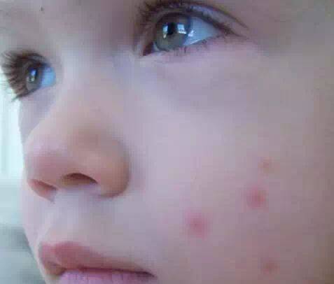 宝宝皮肤红肿起痘痘是什么原因引起的?_螨虫