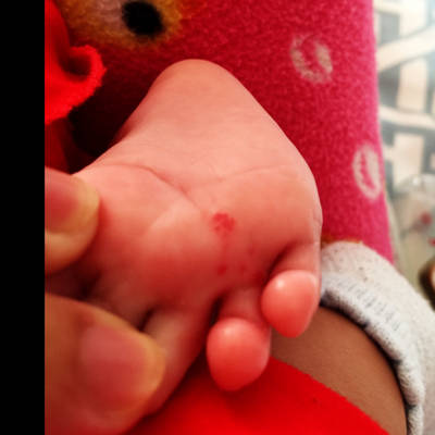孩子出生70多天,不久前发现右脚指缝里有三四个红色的