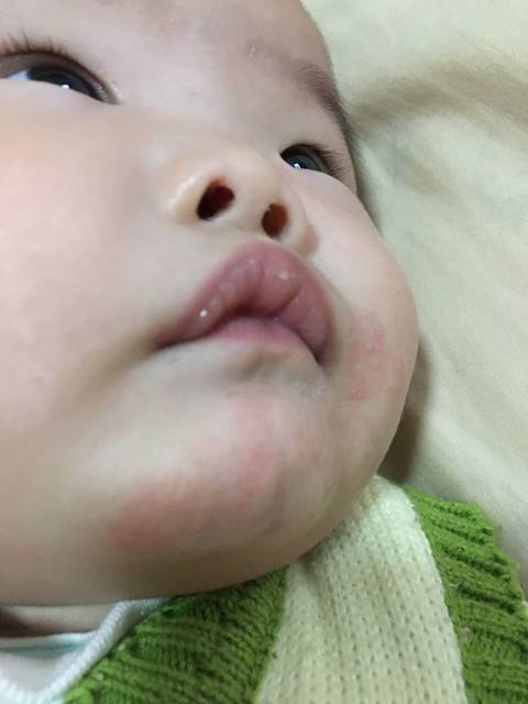 宝宝嘴巴边长红点点,有图,麻烦帮看看_宝宝七