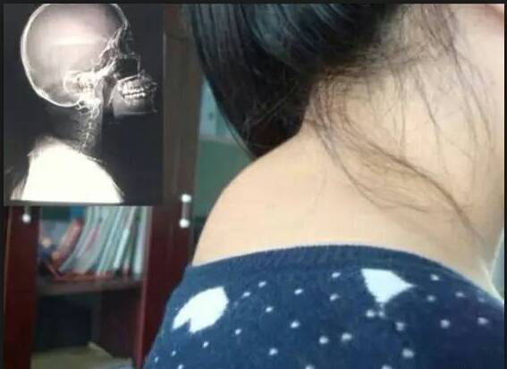 有人脖子后面突出一块肉的吗,好难看_如图,声