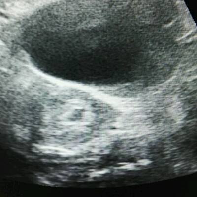 怀孕40 多天,做了B超,说是胚囊不规则,会不会胎
