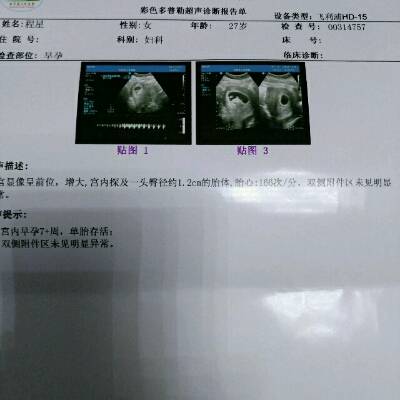 七周B超有积液,开了固肾保胎丸,昨天下午开始