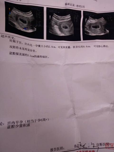 6周B超单_亲们,怀孕6周的B超单,有孕囊,可见胎