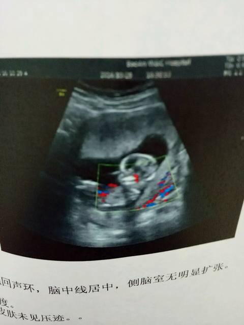 NT是什么?_之前每次检查医生都是宝宝很好,然