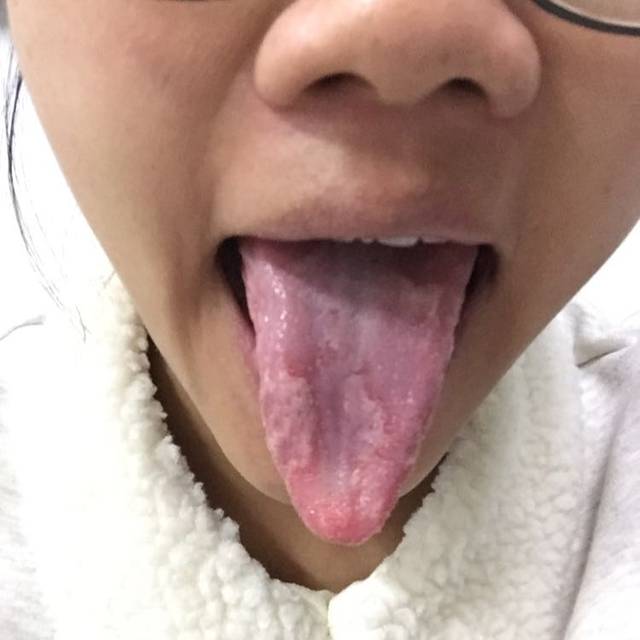孕妇舌头烂_有没有怀孕后舌头一直烂的宝妈,吃