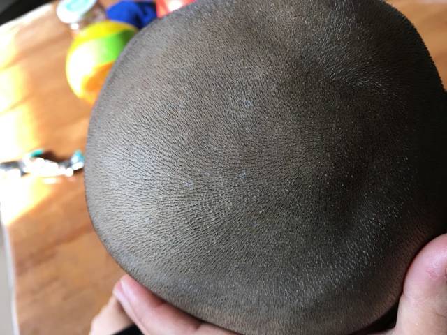 头皮上有好多小白点,有宝妈知道是怎么回事吗