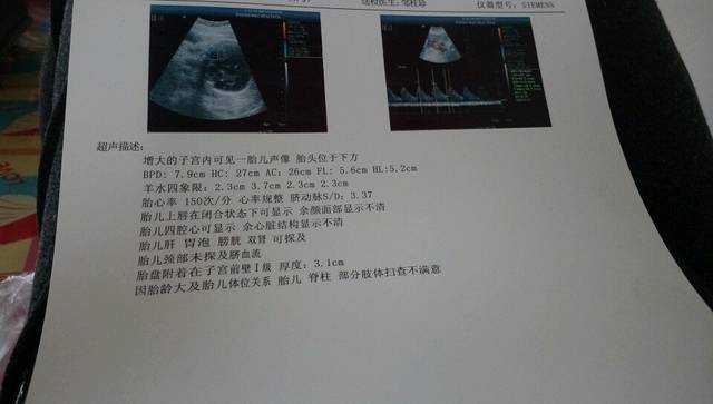 有能看懂b超单的吗?_第一胎不在乎男女只是太好奇了,有能看懂_宝宝树