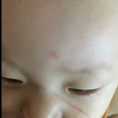 宝宝八个月了,玩玩具的时候脸划伤了,挺长的一