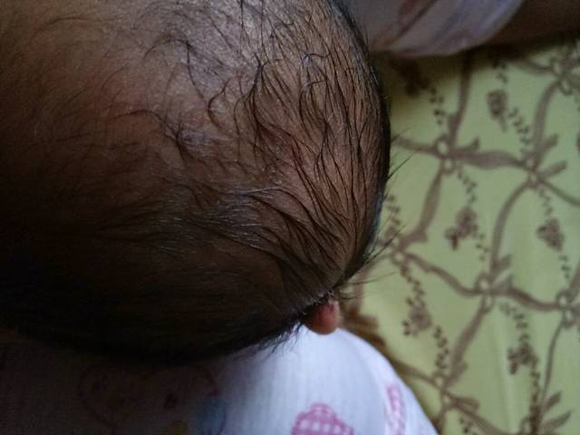 求支招_宝宝二十多天了,头上一直有个大大的软