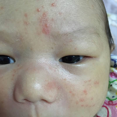 看看宝宝脸上是过敏还是湿疹,如果是湿疹涂什么