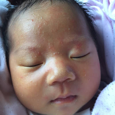 新生儿脸上很多红白色的小点,是湿疹吗?该怎么