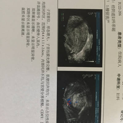 谁能看懂,我周五药流结果,说有血块残留,需要清