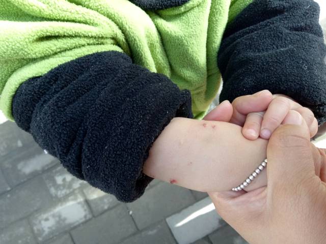 宝宝得丘疹性荨麻疹一月多了疙瘩都没咋消药也