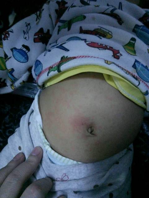 宝宝身上起红点,不是幼儿急疹_求助:八个多月