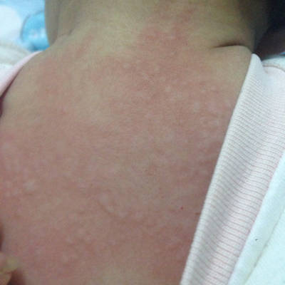 宝宝一周十个月,昨天晚上开始身上出现类似蚊