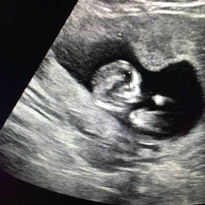 12周+6天,做nt的时候B超发现胎儿后脑勺有一突