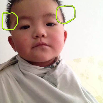 16个月大的宝宝耳朵上面的两侧头骨突出明显