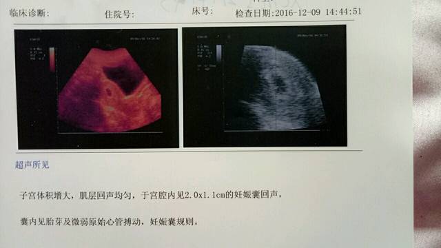 孕囊大小看男女_6周帮忙看看是男是女?