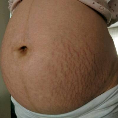 请宝妈们帮我看看男宝女宝,妊辰纹很严重、肚