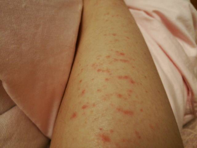 孕三月多,腿上开始长红点,有些痒有些不痒_孕