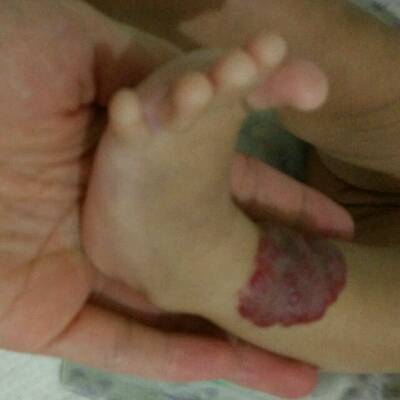 我家宝宝脚腕上有一个大概5cm左右的血管瘤,高出皮肤表面了,前些天她