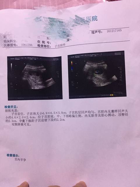 孕酮终于正常了,盆腔积液和宫腔积液也都消失