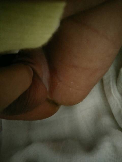 宝宝睾丸和大腿摩擦脱皮怎么处理呢!急…_如题
