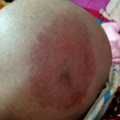 宝宝后脑勺有疤,类似伤口愈合的疤,请问是什麼