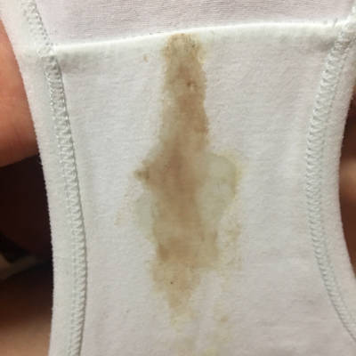 孕24+2,内裤上有褐色分泌物,不知道为什么,昨天