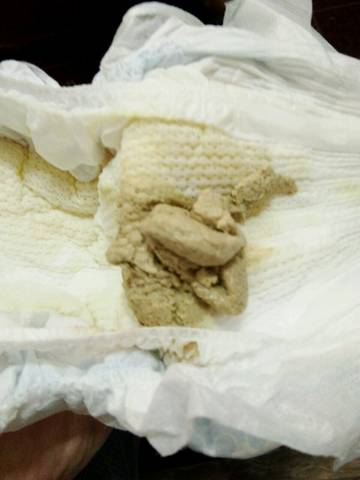 有宝宝的胆道闭锁的吗?_宝妈们,我家宝宝才刚满月,差不多确定_宝宝树