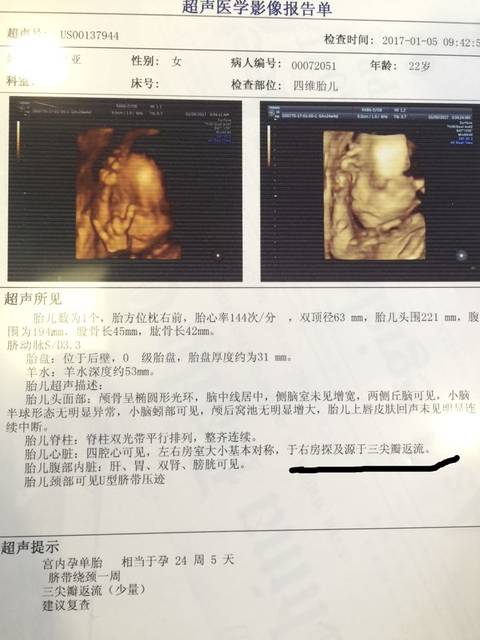 胎儿右房三尖瓣反流少量_前两天四维胎儿右房