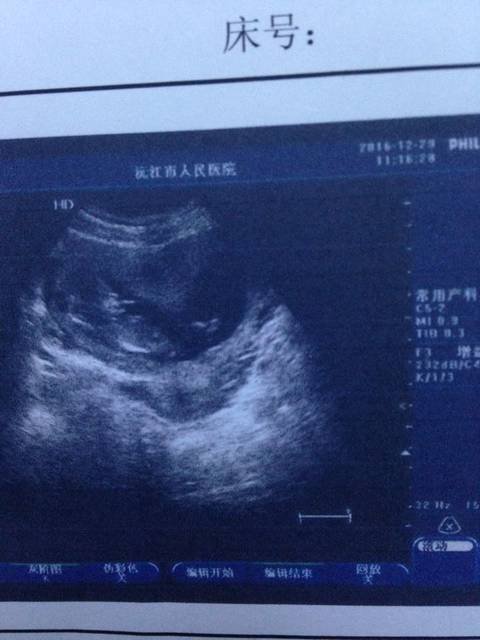 胎儿的嘴里是什么?_nt检查的时候宝贝睡着了,