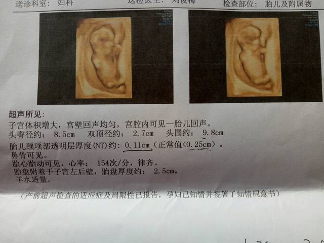 有经验的宝妈帮忙看看是男孩女孩_孕14周nt顺