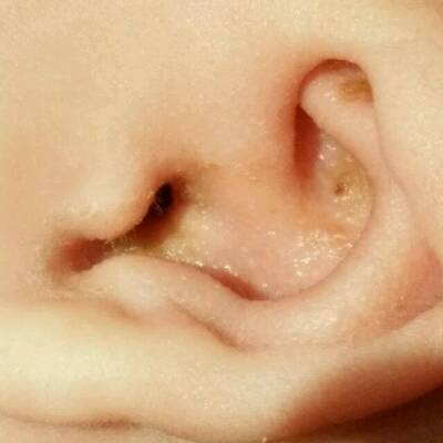 我家宝宝外耳道流了好多黄水,干后结黄痂,尤其耳蜗那里,流的更多.