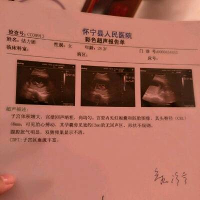 怀孕快十三周,头臀径(cRL)48mm,孕囊宽约