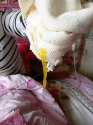 便便有9种颜色,只有3种是健康的(附健康九色卡