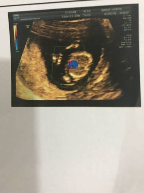 nt检查_做了nt检查,检测报告截图的彩色部分代