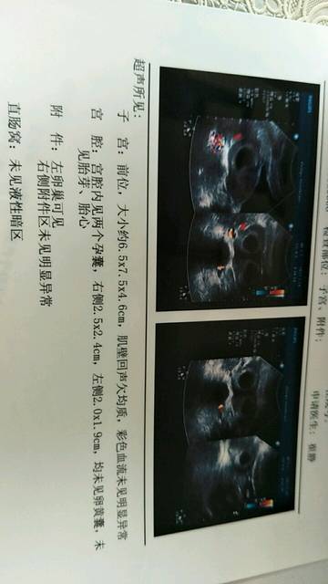 求助,BC查出怀双胎,谁会看是同卵还是异卵_末