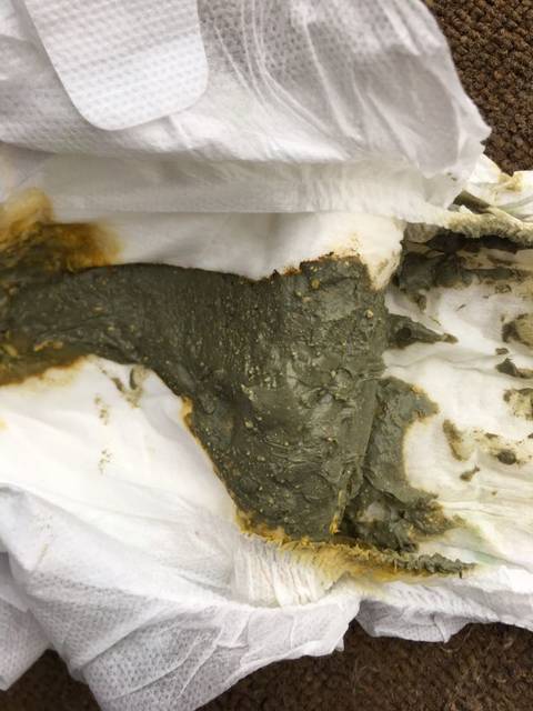 宝宝拉绿便这样正常吗?_宝宝两个月喝合生元