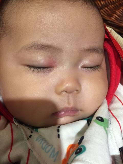 有和我家宝宝一样眼皮发红的么!_眼睑处红已经