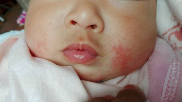 脸上长红点_我家宝宝脸上长了很多这个红点,请