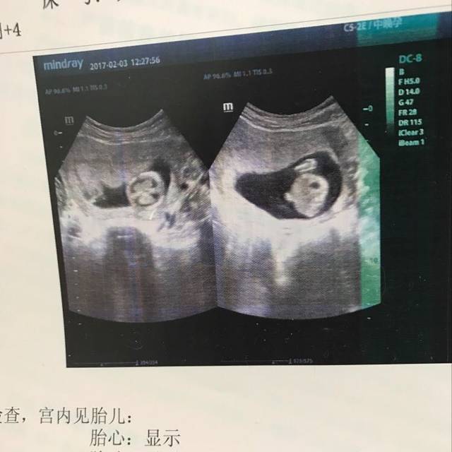 孕十五周B超图,有看的懂的能帮忙看看吧_孕十