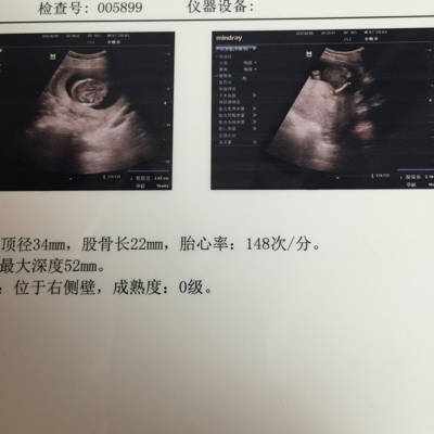 16周+3天b超图,看得出男宝还是女宝吗?医生说是男宝,但是老公说医生语气不肯定,说宝宝腿蛮长的_育儿问答_宝宝树