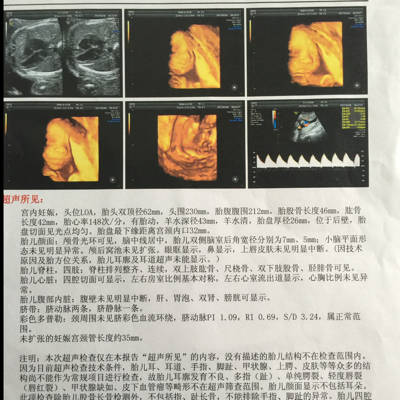 照了四维彩超看到宝宝的样子好开心,亲们会看这彩超单是男孩还是女孩