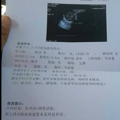 怀孕27周5天 医生说胎儿叫小