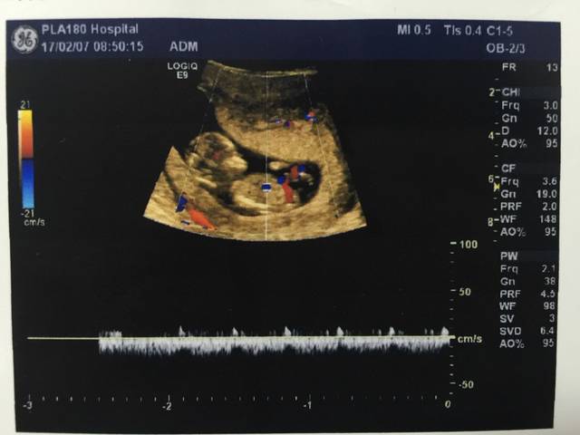 nt图看男女,比较准_大家把nt图发来,要清楚的,要胎儿全身_宝宝树