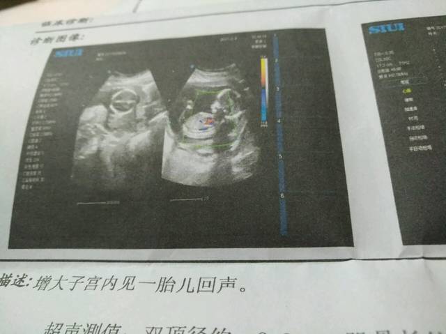 孕十七周,其他正常,就是看到胎儿肚子上有暗区