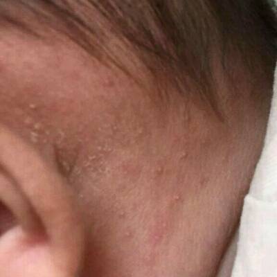 请问这是湿疹吗,宝宝耳朵后面长了好多小红疙瘩